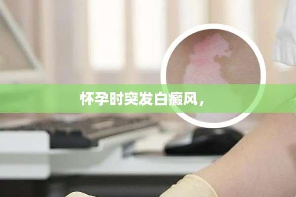 怀孕时突发白癜风,